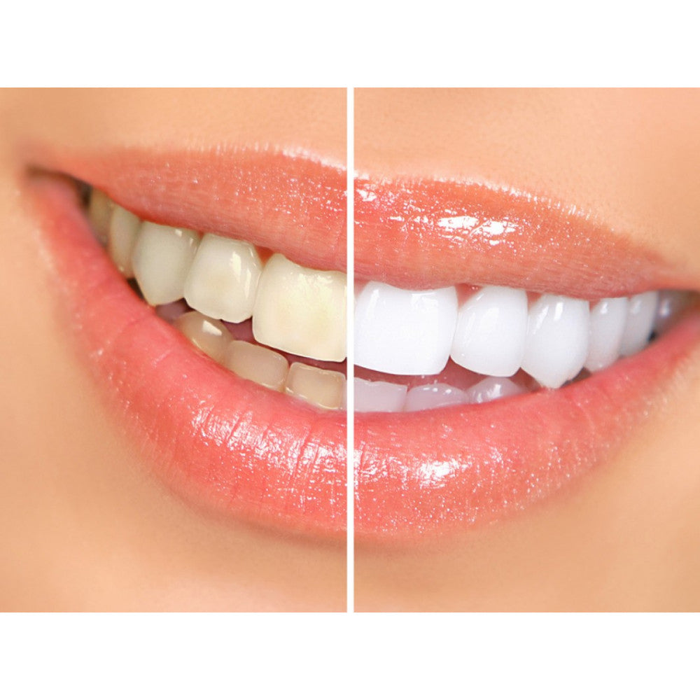 Aparat Albire Dinti Dental White Original TeleshopTV