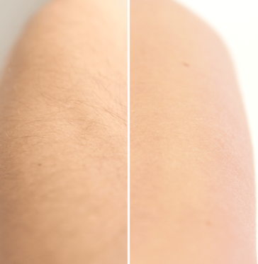 DISPOZITIV DE ÎNDEPĂRTARE A PĂRULUI CU CRISTALE TIP EPILATOR